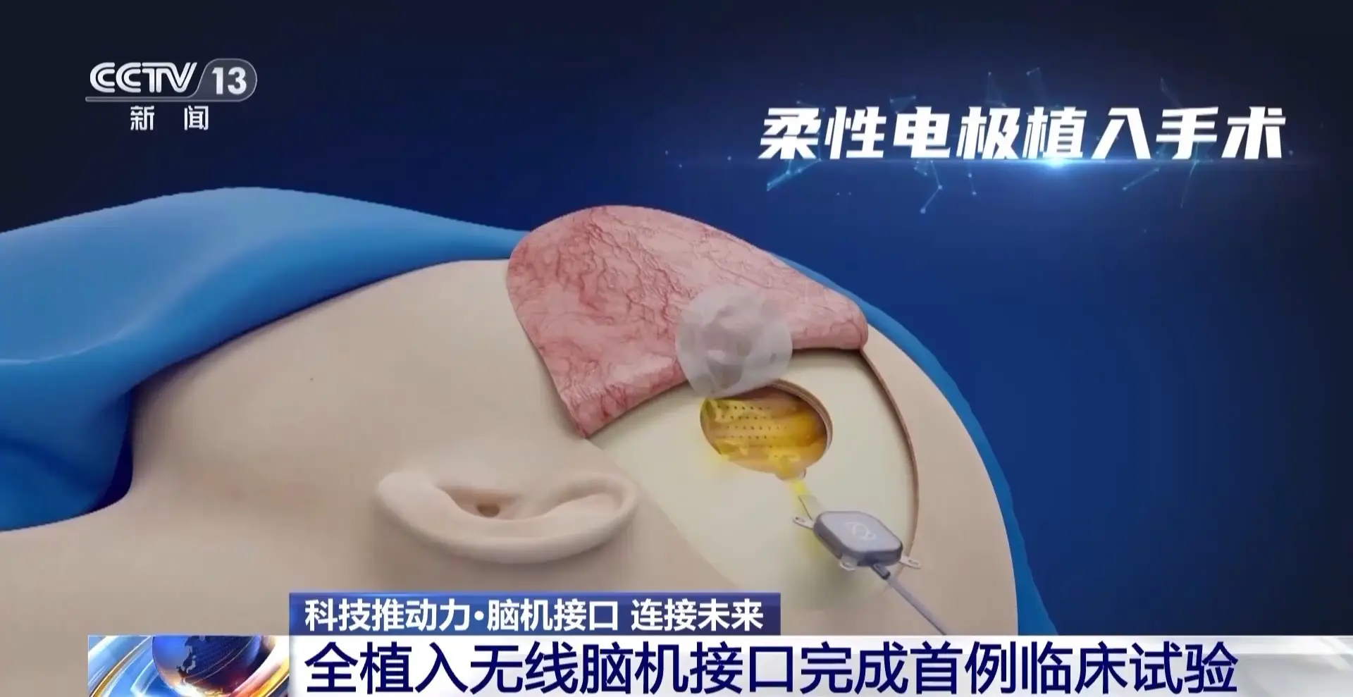 意念操控万物！国产脑机接口逆天突破，瘫痪患者“隔空”打游戏 -1